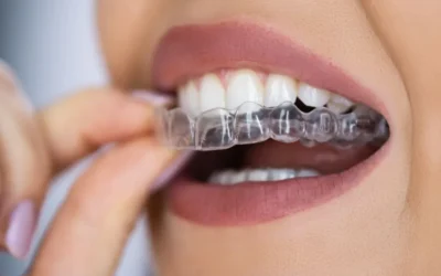 Clear Aligners: The Modern Alternative