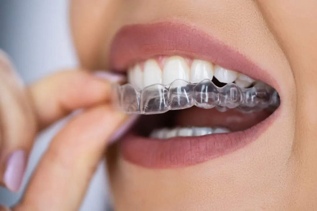 Clear Aligners Sydney Sydney Braces